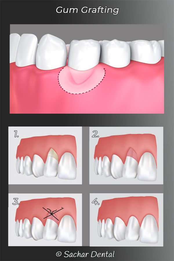 Picture of diagrams explaining periodontal gum grafting