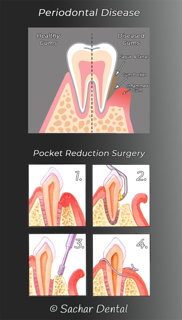 Picture of 2 diagrams explaining periodontal pocket reduction surgery