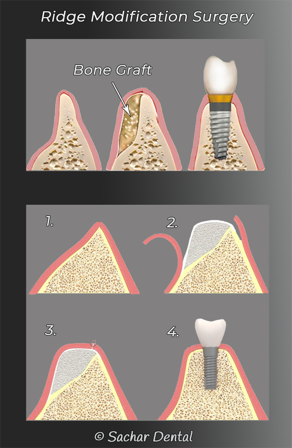 Picture of diagrams explaining periodontal ridge modification surgery