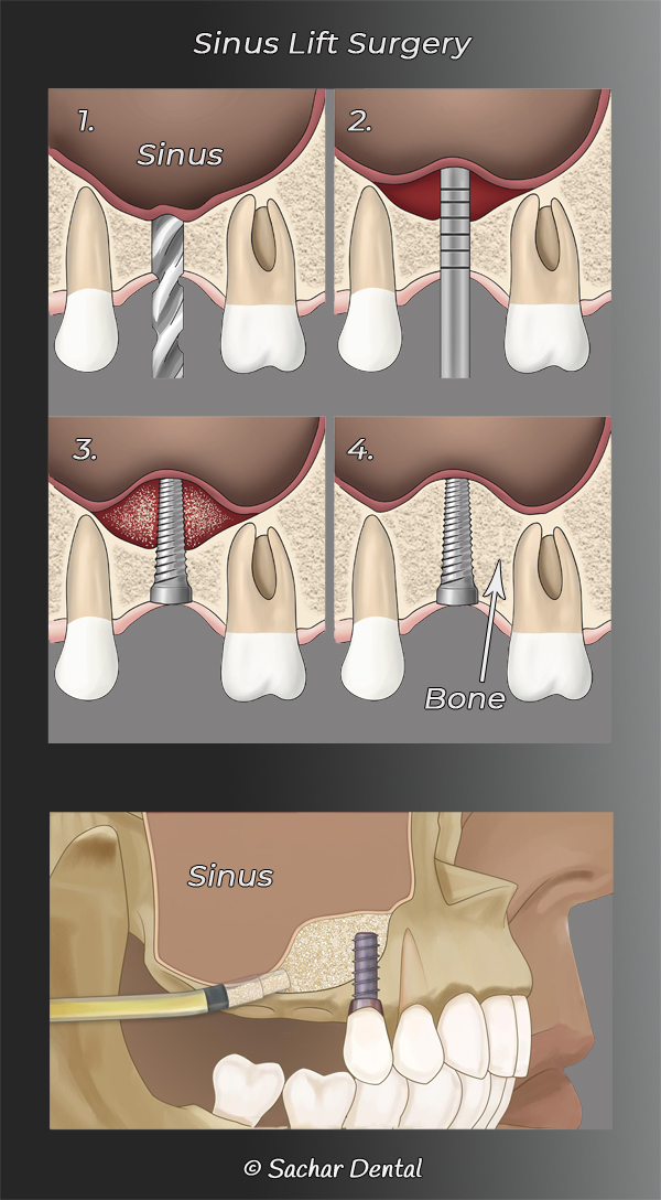 Picture of diagrams explaining periodontal sinus lift surgery and bone graft