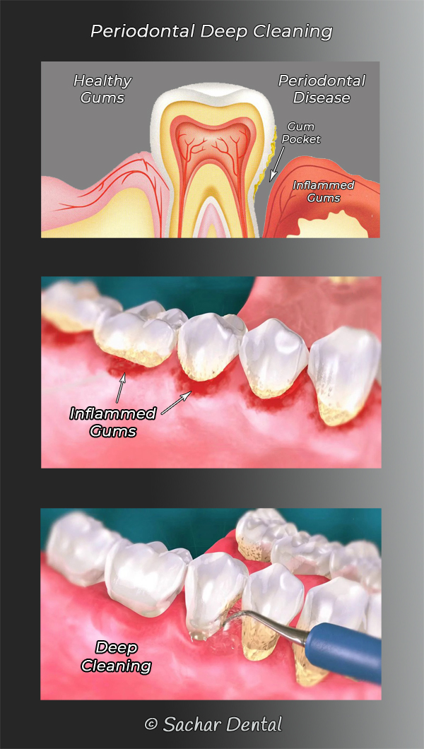 https://www.sachardental.com/wp-content/uploads/2021/05/Periodontist-NYC-deep-cleaning-p01-v01-W600.jpg