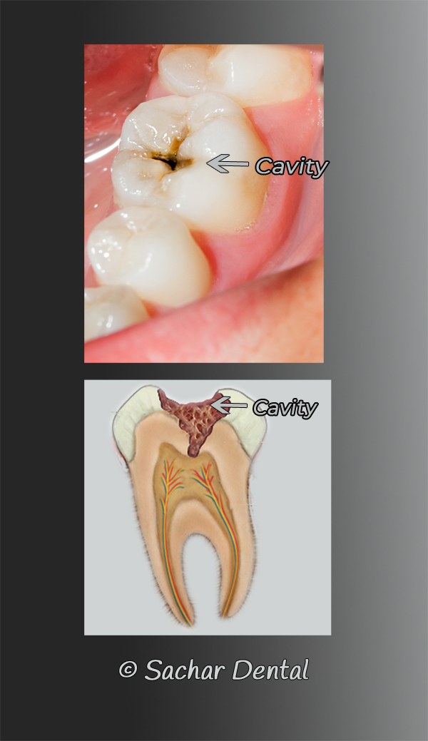 cavity side of molar