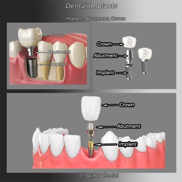 MIRACLE SMILE DENTISTRY, Cosmetic - Implants and Invisalign