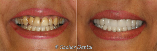 Porcelain Veneers Dentist NYC