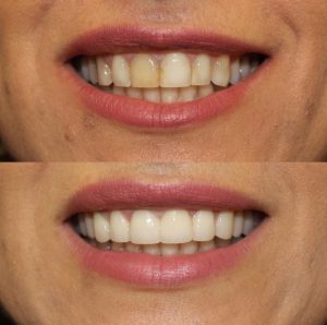 Cosmetic Dentistry Porcelain crowns