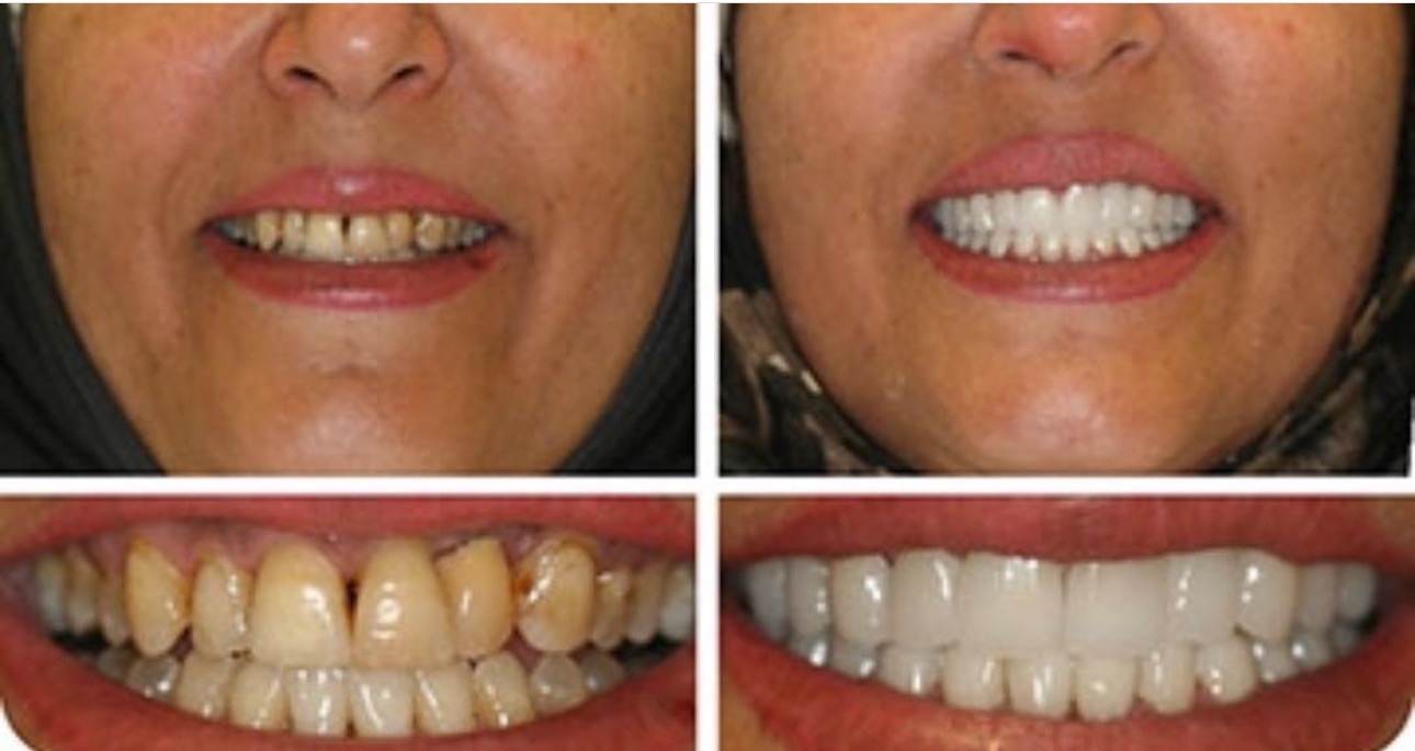 Before and after Cosmetic Porcelain crowns