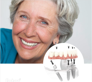 All-on-4 Dental Implants