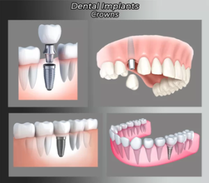 Illustration of Dental Implant Crowns in NYC showing different stages of implant placement and restoration.