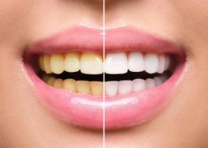 Before and after comparison showing clean white teeth in NYC from professional whitening.