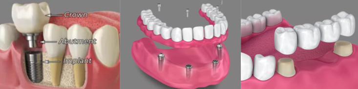 Alternatives to Dentures - Dental Implants, Implant-Supported Dentures, Fixed Bridges Illustration showing three dental restoration options: a single dental implant, implant-supported dentures, and a fixed dental bridge—modern alternatives to traditional dentures.