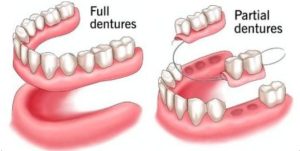 Illustration comparing full vs. partial dentures with visual differences in structure and placement.