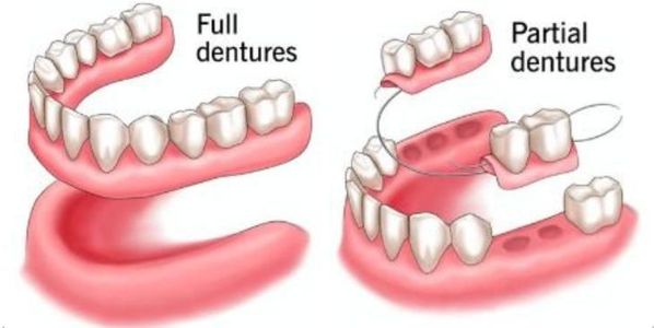 Illustration comparing full vs. partial dentures with visual differences in structure and placement.
