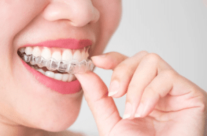 Woman placing a clear aligner on her teeth – best Invisalign in NYC for a confident smile.
