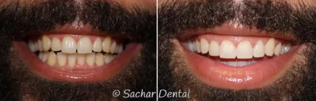 Composite Veneers at Sachar Dental NYC Before and after smile transformation using composite veneers at Sachar Dental NYC.