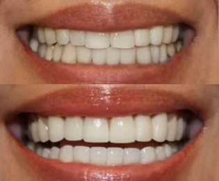 Before and after close-up of a smile transformation using porcelain veneers at Sachar Dental NYC, showing improved alignment and brightness.