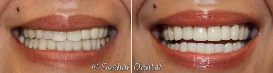 Porcelain Veneers at Sachar Dental NYC Smile transformation showing before and after porcelain veneers treatment at Sachar Dental NYC.