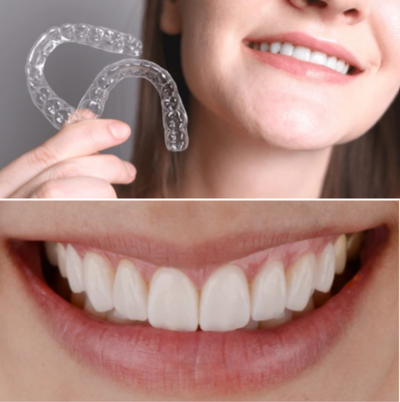 Side-by-side image comparing Invisalign clear aligners and porcelain veneer results on teeth, illustrating options for smile enhancement.
