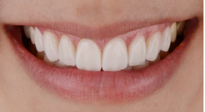 Porcelain Veneers - smile transformation results