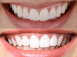 Porcelain Veneers vs Teeth Whitening NYC - smile transformation results