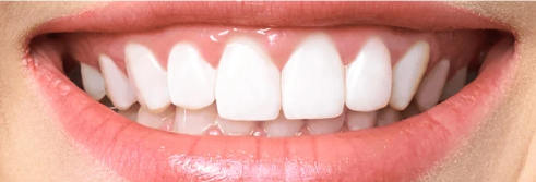 Teeth Whitening in NYC