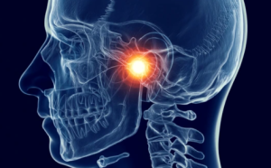 Why did I suddenly get TMJ – X-ray image showing inflamed temporomandibular joint causing sudden jaw pain.