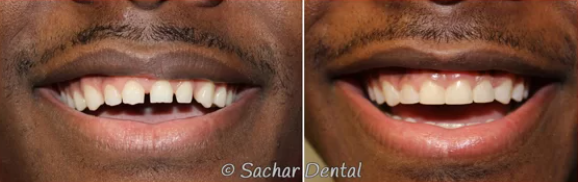 Before and after smile showing teeth improved with bonding veneers at Sachar Dental NYC