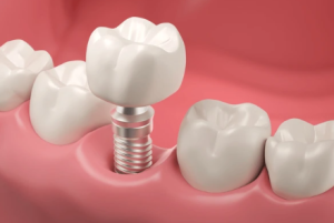 A close-up 3D illustration of a dental implant with crown showing how it integrates into the gum and jawbone, used to explain how painful getting a dental implant is.