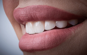 Close-up of a bright, natural smile after Top Cosmetic Dental Treatments showing healthy white teeth.