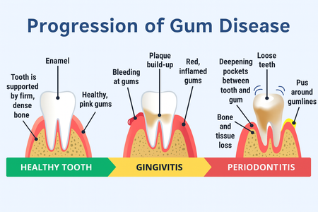 Illustration showing the common signs of gum disease, from healthy gums to gingivitis and periodontitis, including plaque buildup, bleeding gums, inflammation, deep pockets, bone loss, and loose teeth.