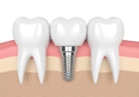 Dentist NYC for Dental Implants